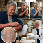 BeeRelief™ | Eliminera psoriasis & hudirritationer med 88% på bara 30 minuter!